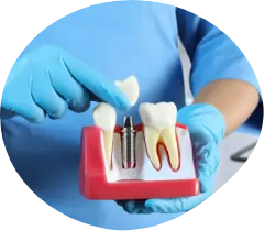 Dental Implants at glebepoint-clinic